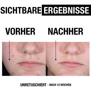 Produktbild für Waschgel Neutrogena Anti-Pickel + Peeling